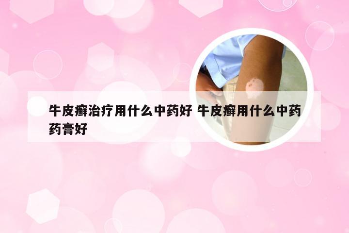 牛皮癣治疗用什么中药好 牛皮癣用什么中药药膏好