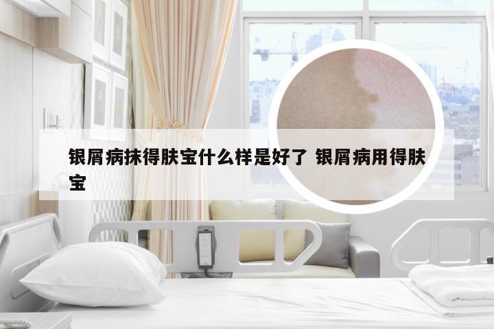 银屑病抹得肤宝什么样是好了 银屑病用得肤宝