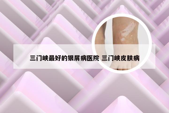 三门峡最好的银屑病医院 三门峡皮肤病