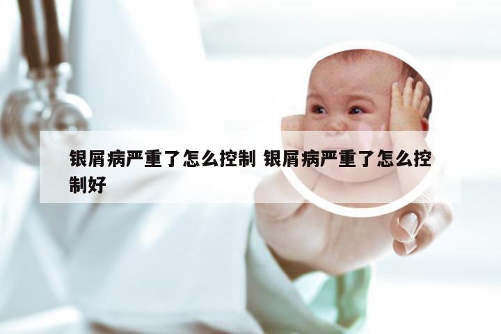 银屑病严重了怎么控制 银屑病严重了怎么控制好