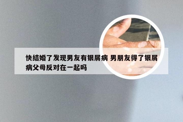 快结婚了发现男友有银屑病 男朋友得了银屑病父母反对在一起吗