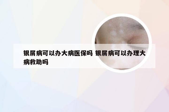 银屑病可以办大病医保吗 银屑病可以办理大病救助吗