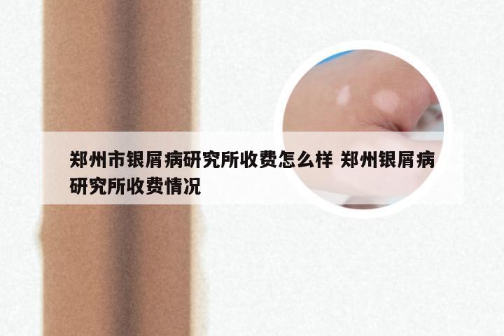 郑州市银屑病研究所收费怎么样 郑州银屑病研究所收费情况