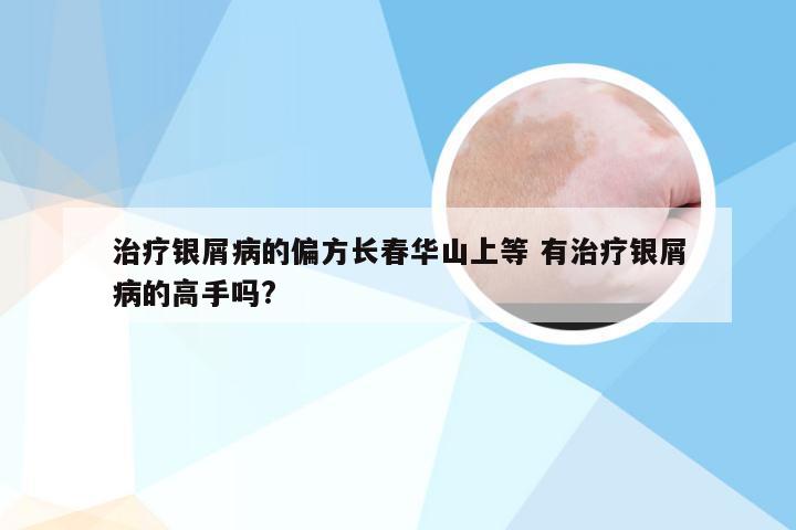 治疗银屑病的偏方长春华山上等 有治疗银屑病的高手吗?