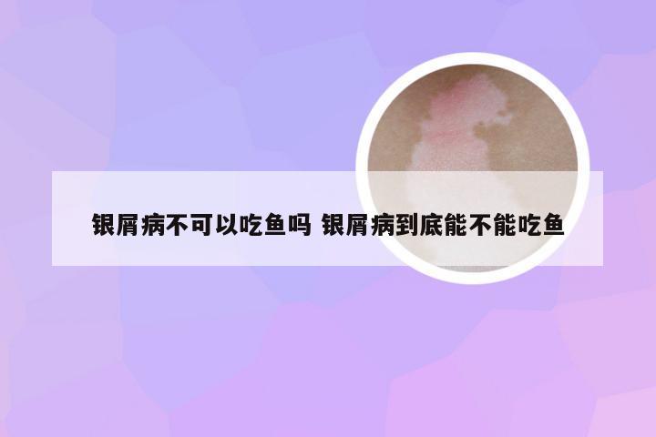 银屑病不可以吃鱼吗 银屑病到底能不能吃鱼