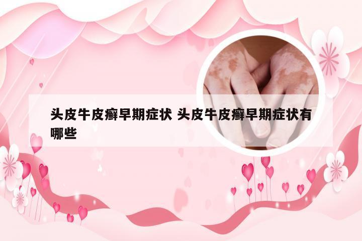 头皮牛皮癣早期症状 头皮牛皮癣早期症状有哪些