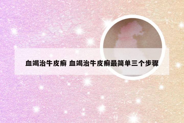 血竭治牛皮癣 血竭治牛皮癣最简单三个步骤