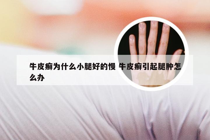 牛皮癣为什么小腿好的慢 牛皮癣引起腿肿怎么办