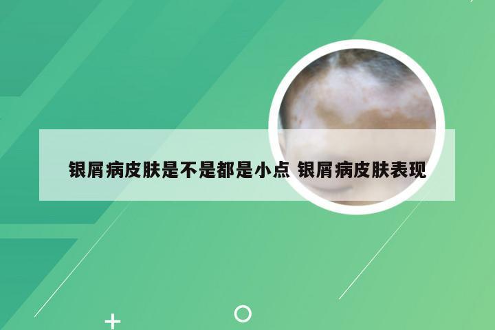 银屑病皮肤是不是都是小点 银屑病皮肤表现