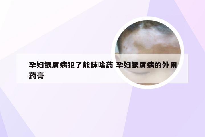 孕妇银屑病犯了能抹啥药 孕妇银屑病的外用药膏