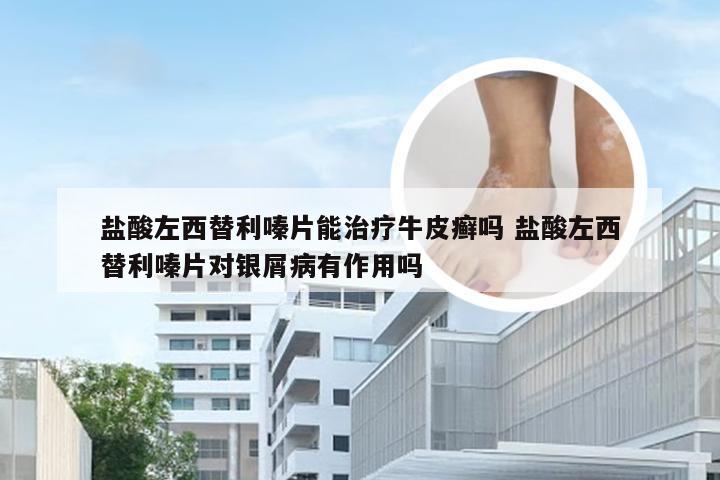 盐酸左西替利嗪片能治疗牛皮癣吗 盐酸左西替利嗪片对银屑病有作用吗