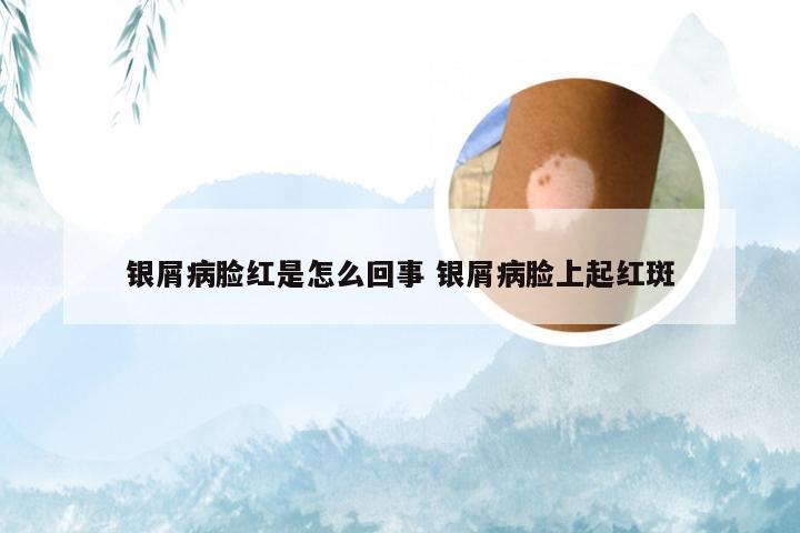 银屑病脸红是怎么回事 银屑病脸上起红斑