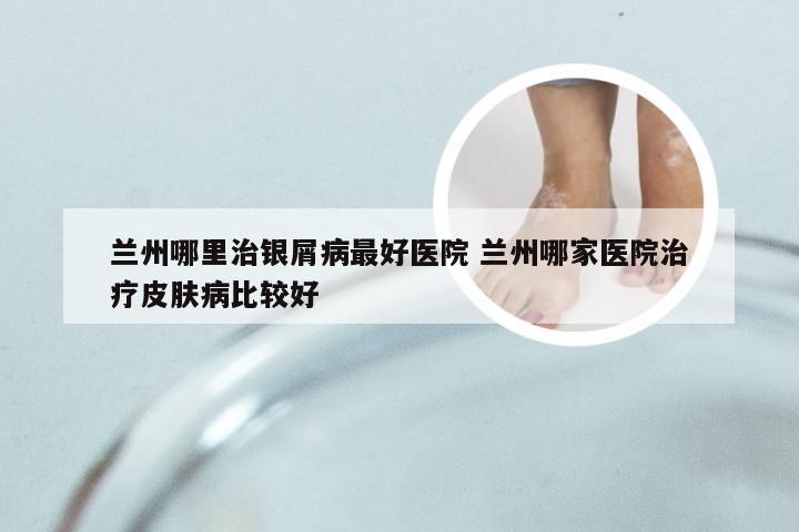 兰州哪里治银屑病最好医院 兰州哪家医院治疗皮肤病比较好