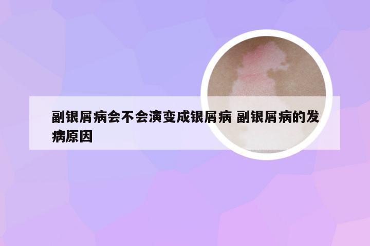 副银屑病会不会演变成银屑病 副银屑病的发病原因