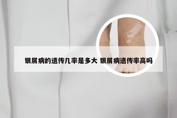 银屑病的遗传几率是多大 银屑病遗传率高吗