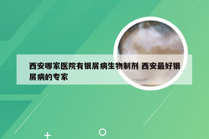 西安哪家医院有银屑病生物制剂 西安最好银屑病的专家