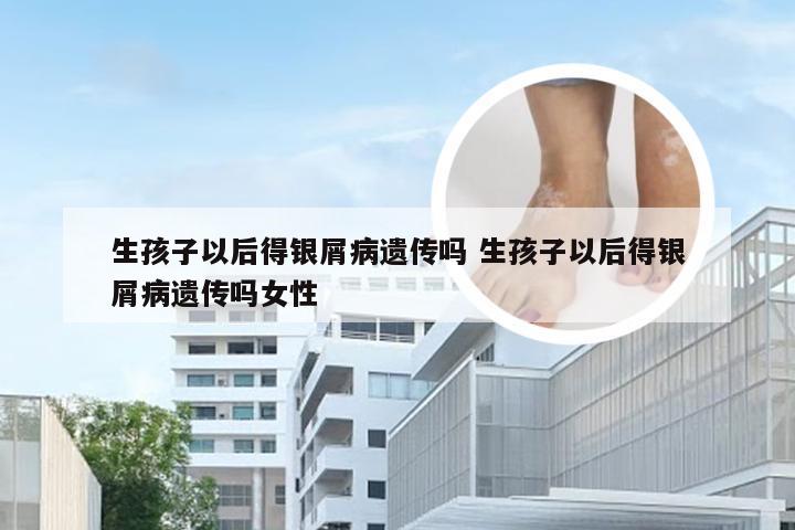 生孩子以后得银屑病遗传吗 生孩子以后得银屑病遗传吗女性