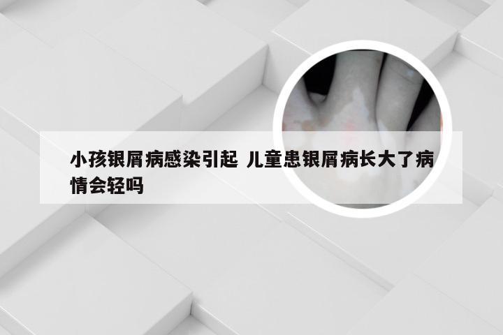 小孩银屑病感染引起 儿童患银屑病长大了病情会轻吗