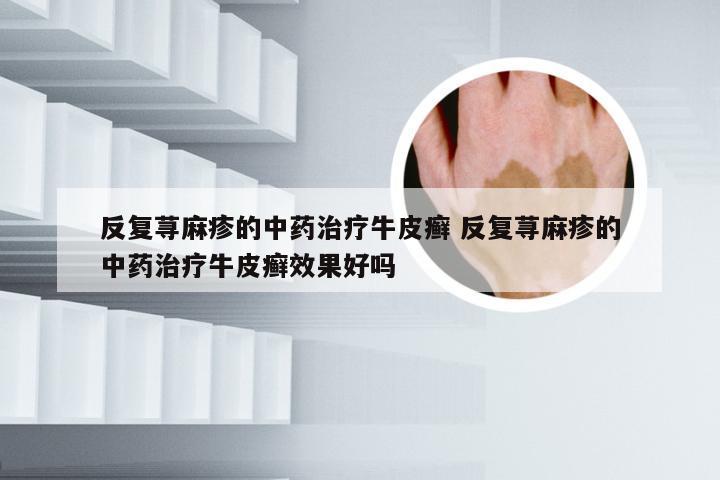 反复荨麻疹的中药治疗牛皮癣 反复荨麻疹的中药治疗牛皮癣效果好吗