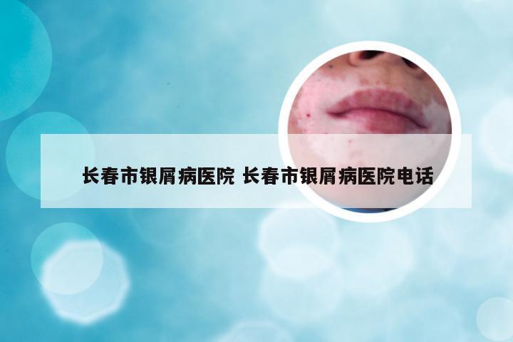 长春市银屑病医院 长春市银屑病医院电话