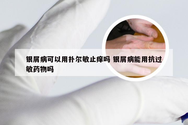 银屑病可以用扑尔敏止痒吗 银屑病能用抗过敏药物吗