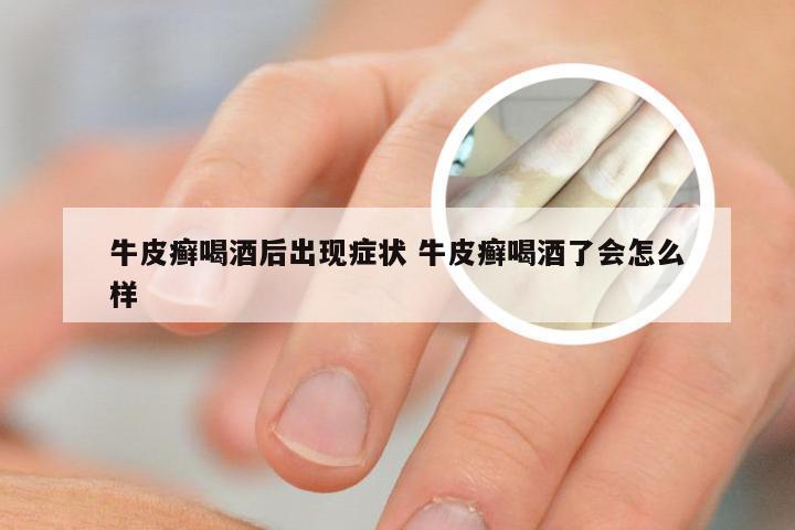 牛皮癣喝酒后出现症状 牛皮癣喝酒了会怎么样