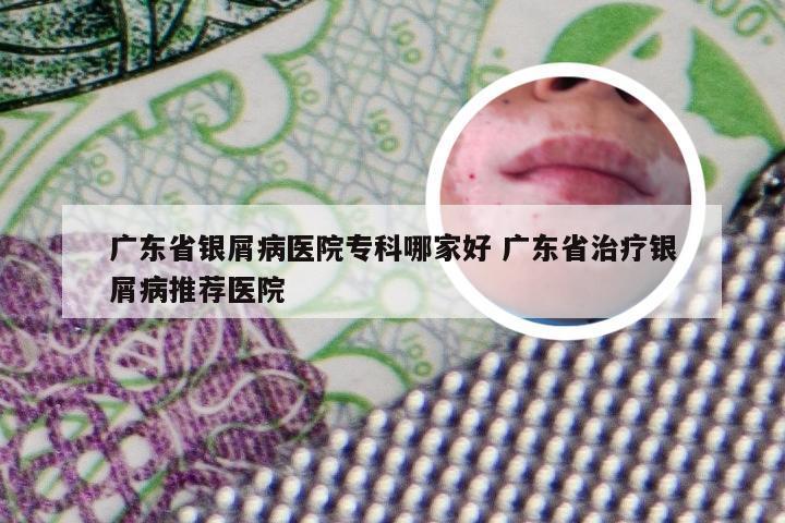 广东省银屑病医院专科哪家好 广东省治疗银屑病推荐医院