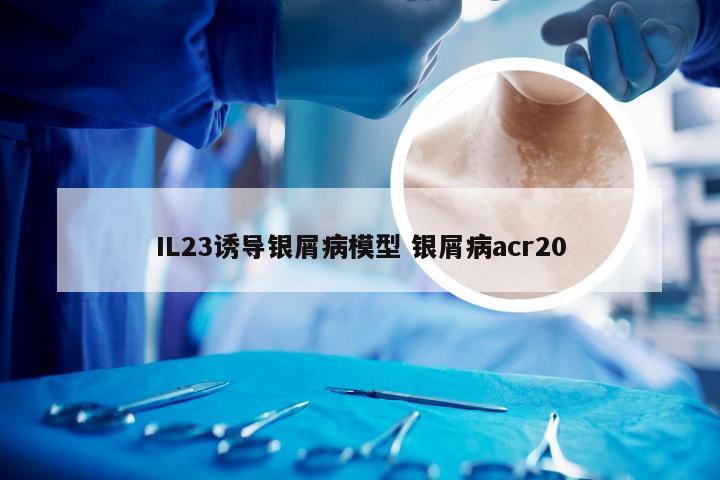 IL23诱导银屑病模型 银屑病acr20