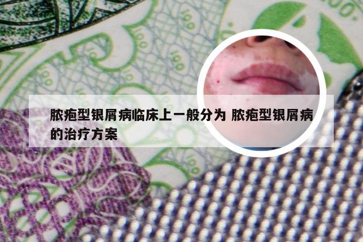脓疱型银屑病临床上一般分为 脓疱型银屑病的治疗方案