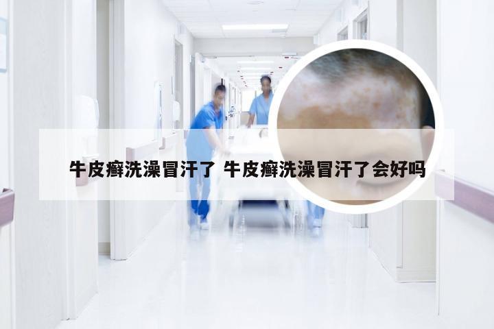 牛皮癣洗澡冒汗了 牛皮癣洗澡冒汗了会好吗