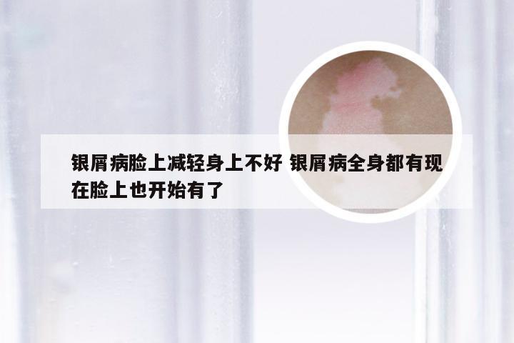银屑病脸上减轻身上不好 银屑病全身都有现在脸上也开始有了