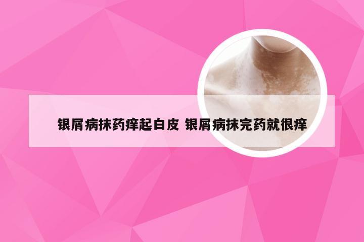 银屑病抹药痒起白皮 银屑病抹完药就很痒