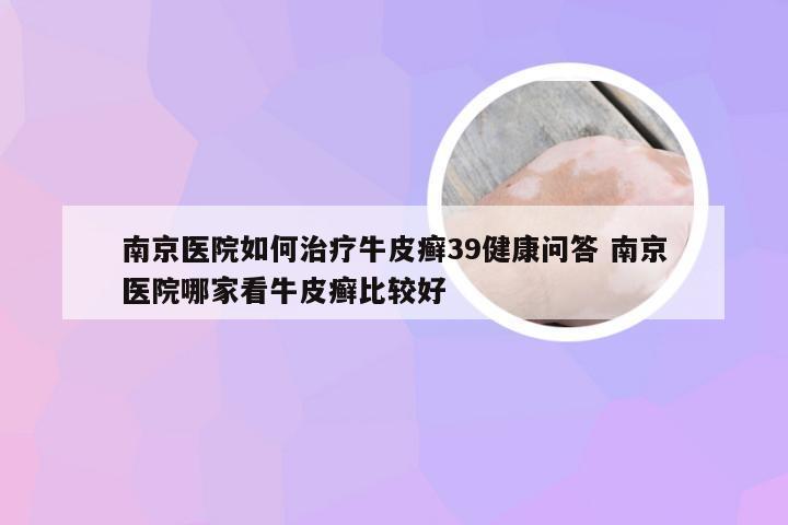 南京医院如何治疗牛皮癣39健康问答 南京医院哪家看牛皮癣比较好