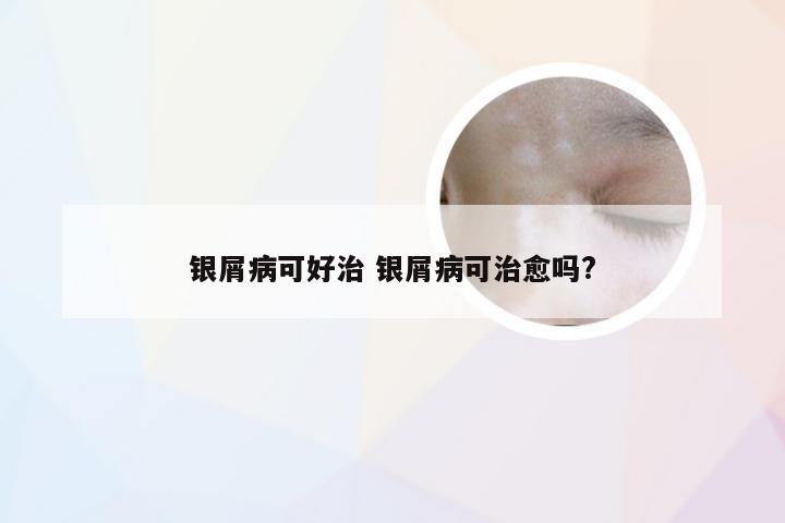 银屑病可好治 银屑病可治愈吗?