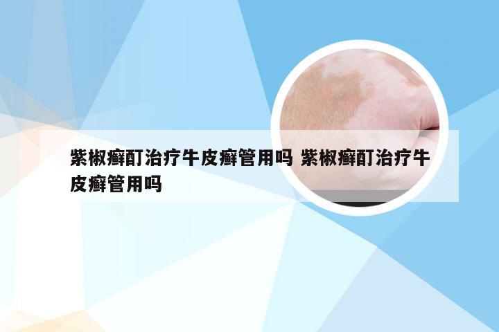 紫椒癣酊治疗牛皮癣管用吗 紫椒癣酊治疗牛皮癣管用吗