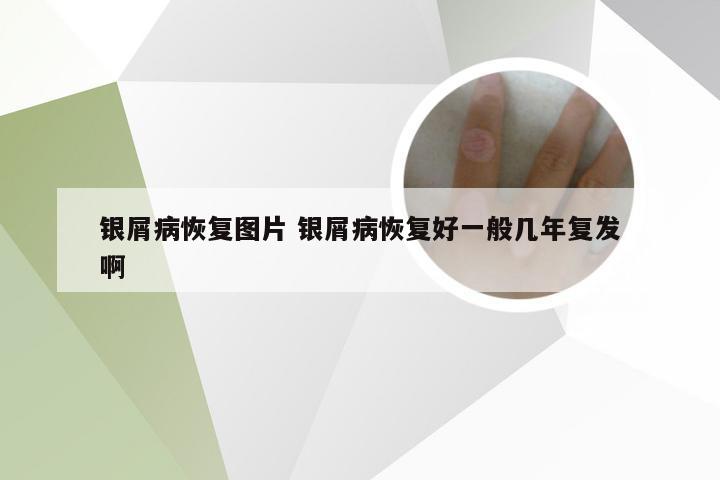 银屑病恢复图片 银屑病恢复好一般几年复发啊