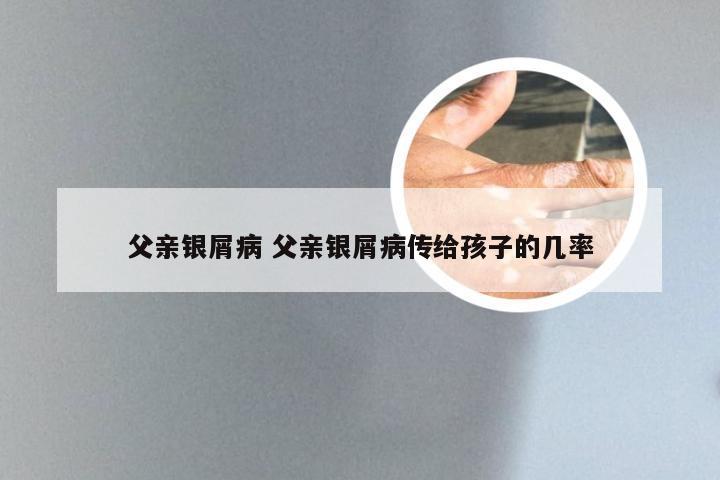 父亲银屑病 父亲银屑病传给孩子的几率