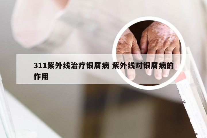 311紫外线治疗银屑病 紫外线对银屑病的作用