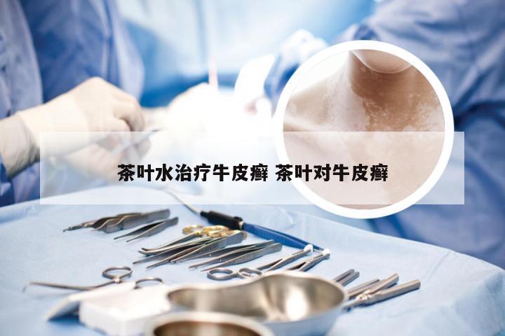 茶叶水治疗牛皮癣 茶叶对牛皮癣