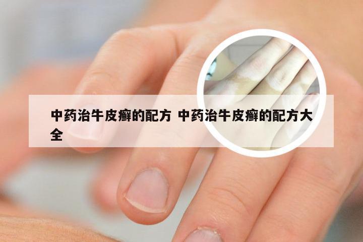 中药治牛皮癣的配方 中药治牛皮癣的配方大全