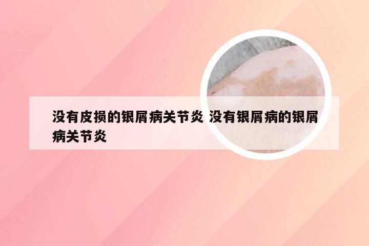 没有皮损的银屑病关节炎 没有银屑病的银屑病关节炎