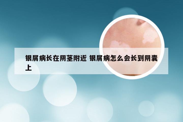 银屑病长在阴茎附近 银屑病怎么会长到阴囊上