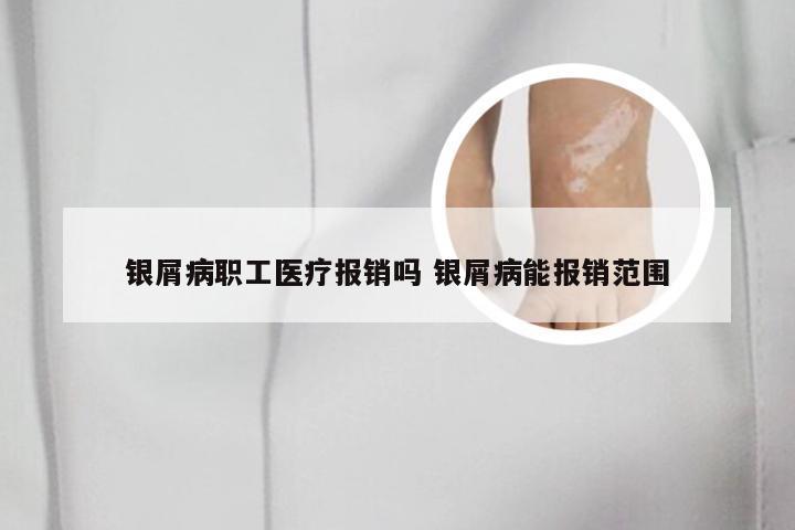 银屑病职工医疗报销吗 银屑病能报销范围