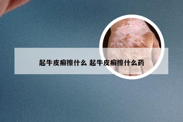 起牛皮癣擦什么 起牛皮癣擦什么药