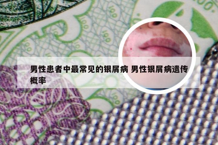 男性患者中最常见的银屑病 男性银屑病遗传概率
