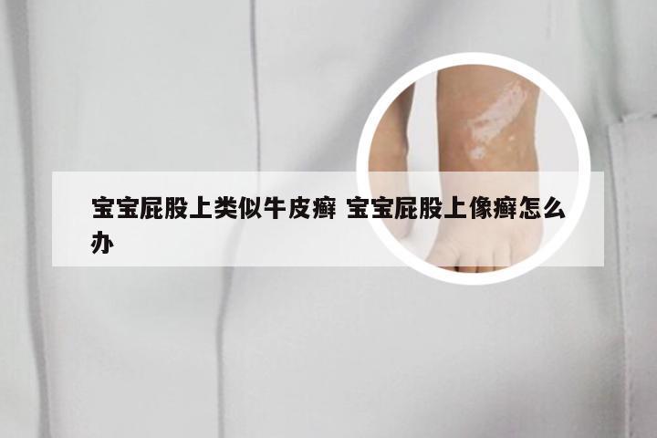 宝宝屁股上类似牛皮癣 宝宝屁股上像癣怎么办