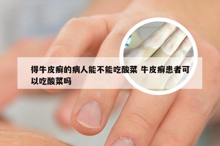 得牛皮癣的病人能不能吃酸菜 牛皮癣患者可以吃酸菜吗