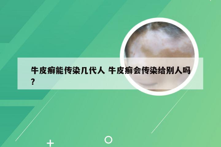 牛皮癣能传染几代人 牛皮癣会传染给别人吗?