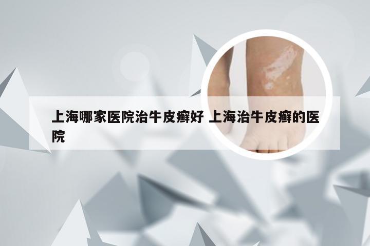上海哪家医院治牛皮癣好 上海治牛皮癣的医院