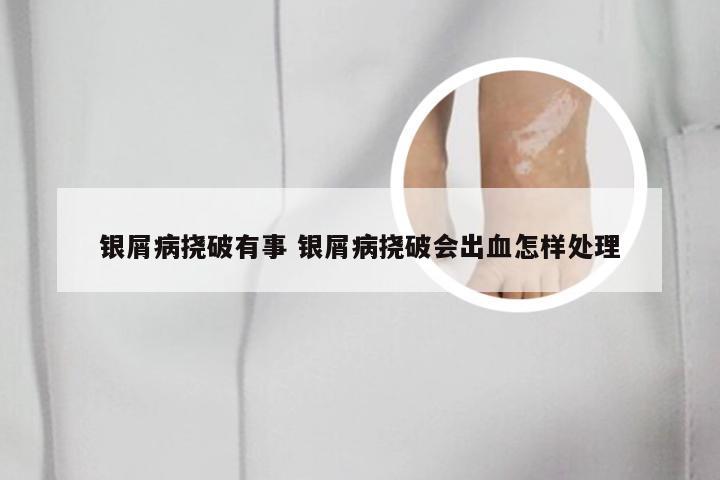 银屑病挠破有事 银屑病挠破会出血怎样处理